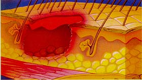 Stage III Pressure Ulcers