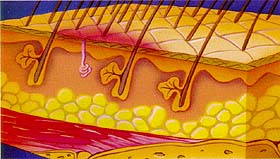 The Frist Stage of a Pressure Sore