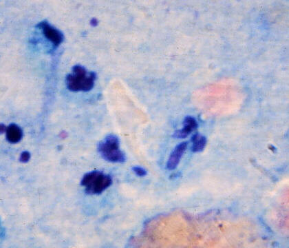 Hooklets, typical of Echinococcus granulosus, FNA right lung mass, 1,000x Papanicolaou staining