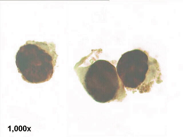 Decoy cells, SV-40 immune staining, high power view shows strongly positive cells