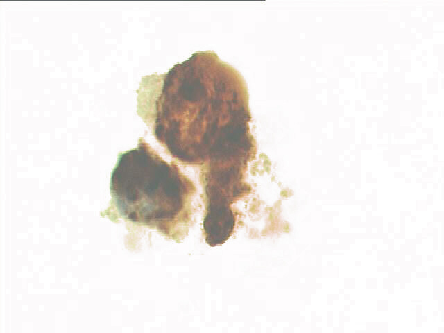 Decoy cells, SV-40 immune staining, high power view shows strongly positive cells