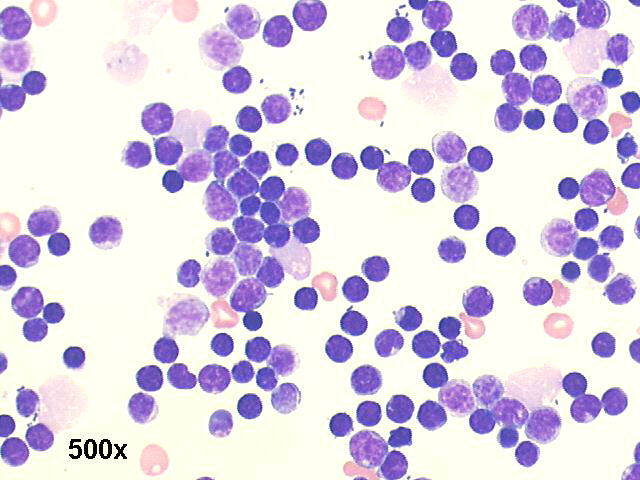 Cystic lymphangioma, 500x M-G-G staining, many mature lymphocytes