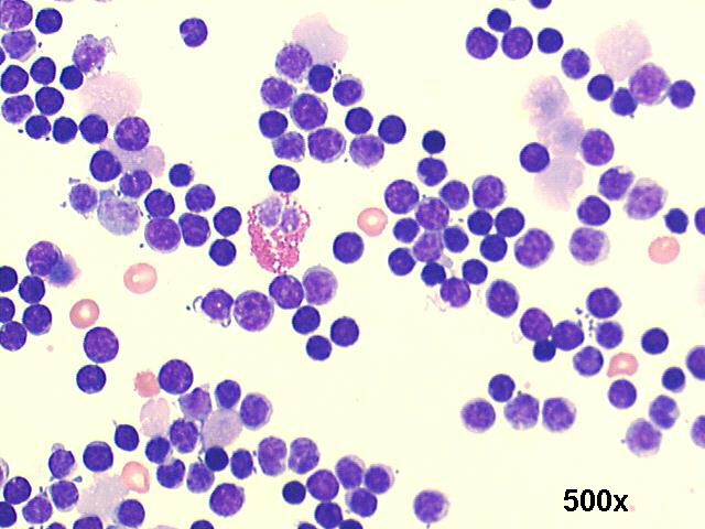 Cystic lymphangioma, 500x M-G-G staining, many mature lymphocytes, isolated eosinophyl