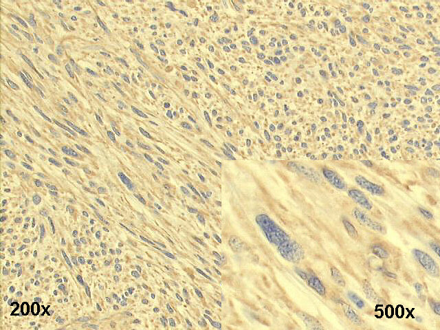 Vimentin immnuno-histochemistry ~ many fusiform, Vimentin positive cells
