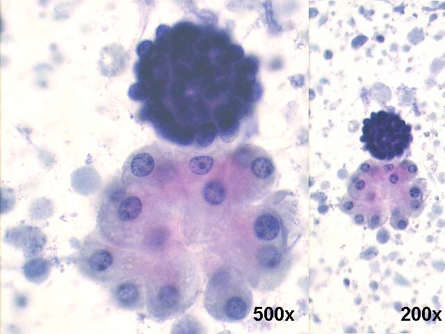 200x and 500x Pap., a hyperchromatic epithelial cell ball, and a cluster of benign looking metaplastic apocrine cells.