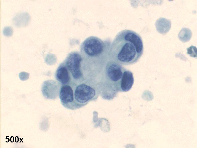 500x, Pap. staining, cluster of atypical cells