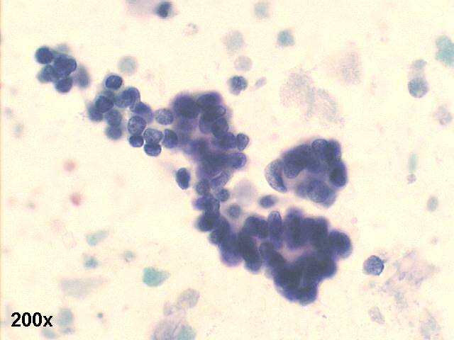 200x, Pap staining, pseudo-papillary fragment