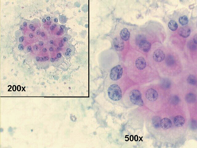 200x and 500x Pap staining, and a cluster of benign looking metaplastic apocrine cells in a proteinaceous background.
