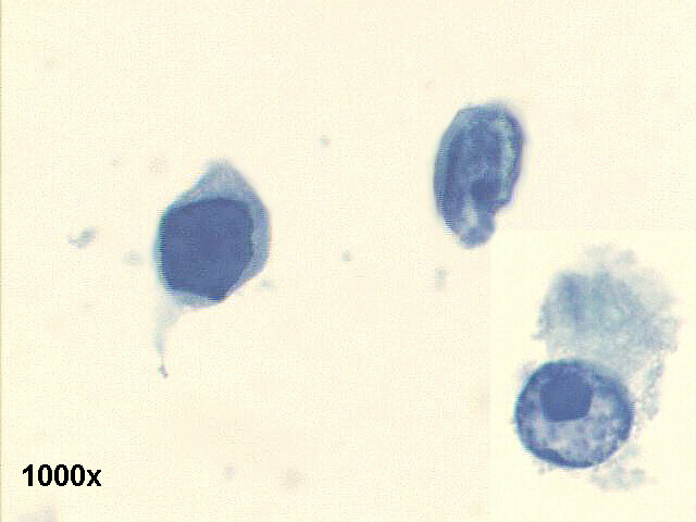 Decoy cells, Pap staining, high power view shows abnormal looking tubular cells, with inclusion bearing nuclei