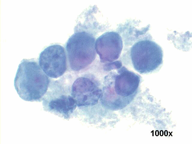 Decoy cells, Pap staining, high power view shows a group of abnormal looking tubular cells, with inclusion bearing nuclei