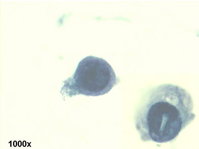 Decoy cells, Pap staining, high power view shows abnormal looking tubular cells, with inclusion bearing nuclei, and a crystaloid structure