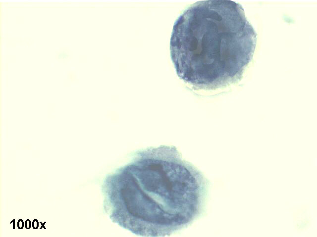 Decoy cells, Pap staining, high power view shows abnormal looking tubular cells, with clumped chromatin and a crystaloid nuclear inclusion