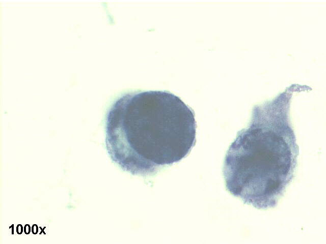 Decoy cells, Pap staining, high power view shows two abnormal looking cells, one with with an inclusion bearing nucleus, and the other with irregular clumping of chromatin