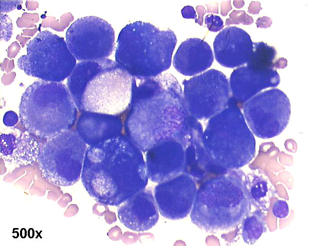 Pleural fluid, metastatic gastric signet ring carcinoma, 500x M-G-G staining,  many isolated large malignant cells.