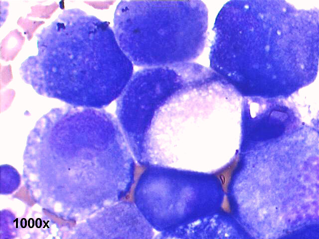 Pleural fluid, metastatic gastric signet ring carcinoma, 1000x Papanicolaou staining, in detail a typical signet ring cell, with large mucin filled vacuole pushing the nucleus to the periphery of the cell.