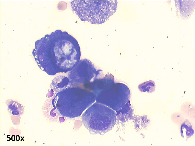 Pleural fluid, metastatic gastric signet ring carcinoma, 500x M-G-G staining, isolated large malignant cells