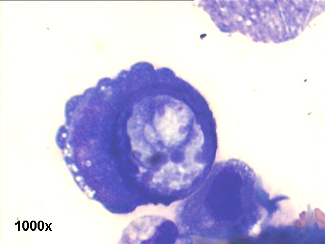 Pleural fluid, metastatic gastric signet ring carcinoma, 1000x M-G-G staining, in detail a typical signet ring cell, with large vacuole pushing the nucleus to the periphery of the cell.