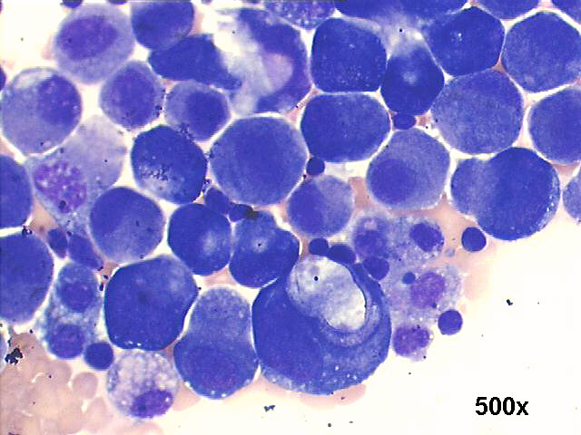 Pleural fluid, metastatic gastric signet ring carcinoma, 500x M-G-G staining, many isolated large malignant cells, some with signet ring morphology.