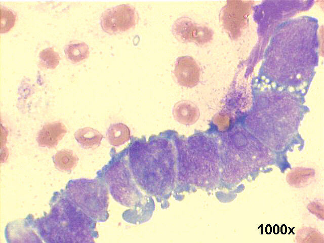 1000x M-G-G staining, high power view, of tandem pattern,  see the cytoplasmic projections, and the tiny clear vacuoles. Some nucleoli are visible.