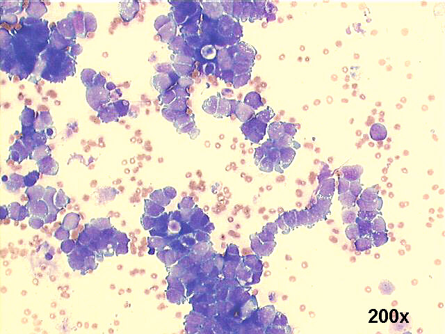 200x M-G-G staining, loose groups of small cells, with nuclear molding and tandem pattern