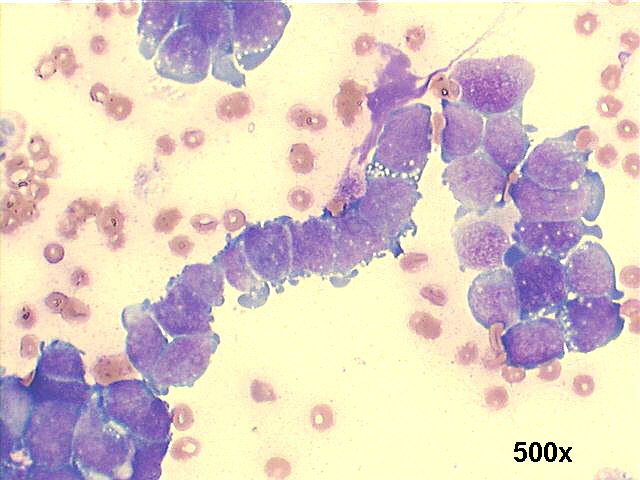 500x M-G-G staining, detail view of the tandem pattern, nuclear molding and very scant blue cytoplasm, tiny clear vacuoles