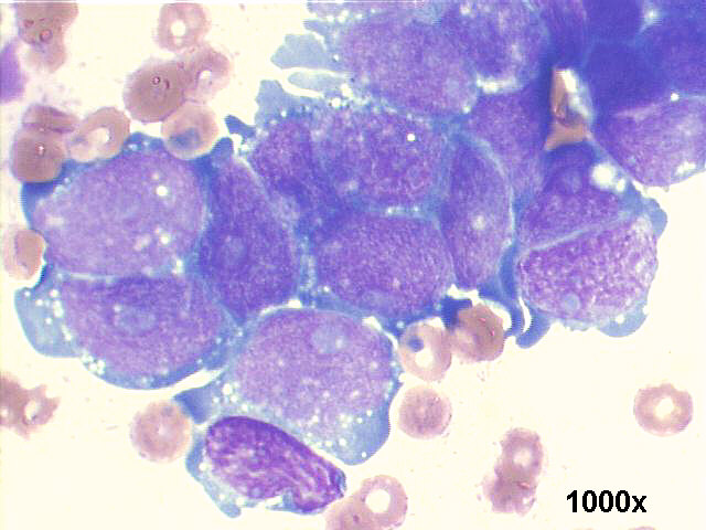 1000x M-G-G staining, high power view, the blue nucleoli, and cytoplasmic projections are clearly seen