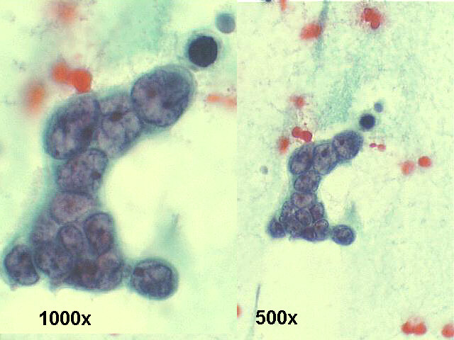 1000x and 500x Papanicolaou staining, three-dimensional loose group of small cells, with very high N/C ratio, small and medium sized nucleoli are seen, salt and pepper chromatin pattern.