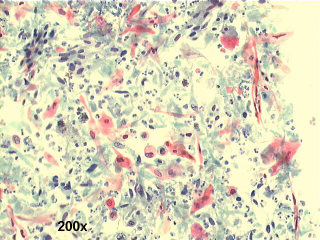 200x Papanicolaou staining, many isolated squamous cells, most of them fiberlike