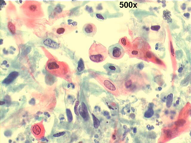 500x Pap staining, high power view of above, many isolated squamous cells, most of them fiberlike