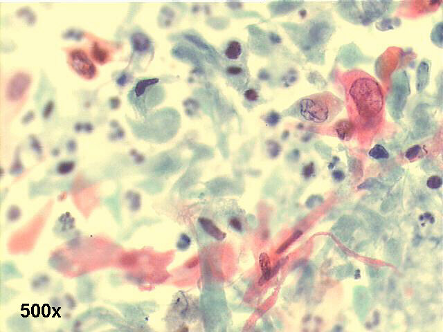 500x Pap staining, many isolated squamous cells, some ghost cells