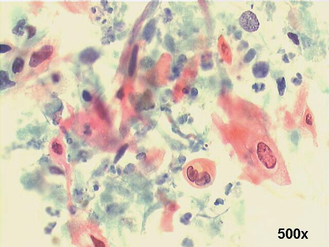 500x Pap staining, many isolated squamous cells, some ghost cells