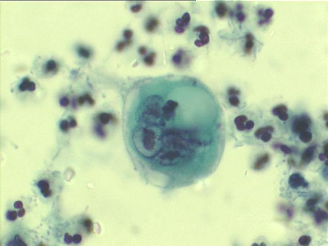 Herpes virus 1,000x Pap staining: large intranuclear inclusion, Cowdry A