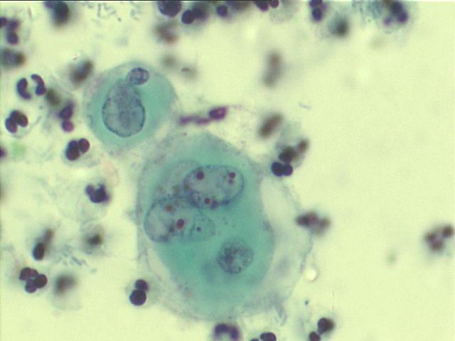 Herpes virus 1,000x Pap staining, ground glass chromatin