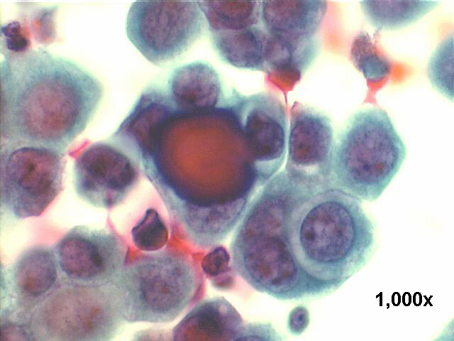 papillary carcinoma, endometrium, 1000x Pap staining, high power view of psammoma body, and cell inside cell arrangement.