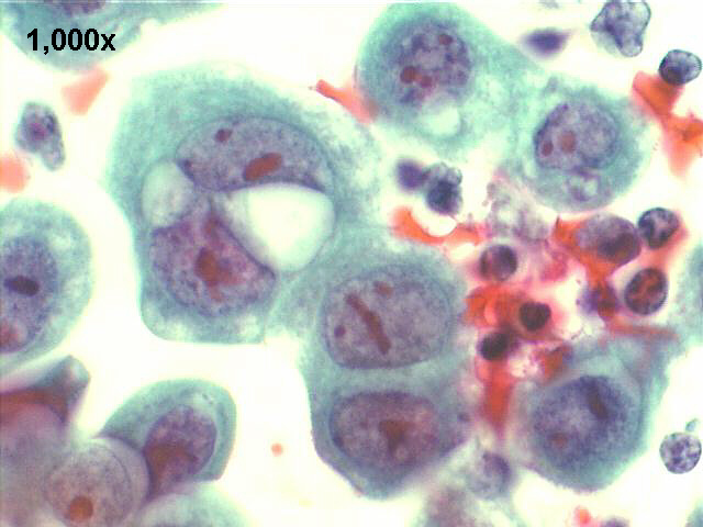 papillary carcinoma, endometrium, 1000x Pap staining, slits between cells, and cells grasping other cells, suggestion of microvilli in their surface.