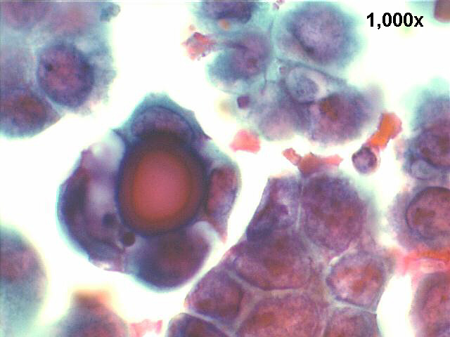 1000x Pap staining, high power view of previous picture.