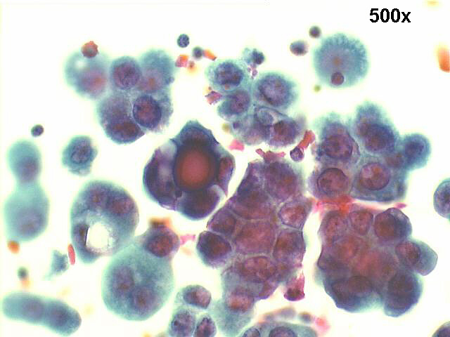 papillary carcinoma, endometrium, 500x Pap staining, acinar groups of cells, and psammoma body.