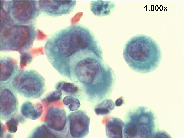papillary carcinoma, endometrium, 1000x Pap staining, another high power view of cell grasping.
