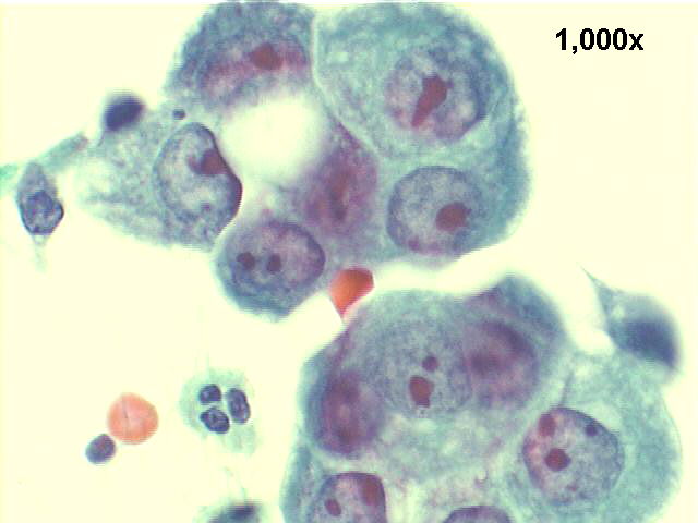 papillary carcinoma, endometrium, 1000x Pap staining, high power view of malignant cells in acinar arrangement. Notice very large and irregular nucleoli.