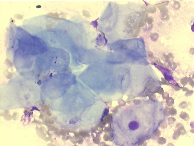 ovarian dermoid cyst 500x M-G-G staining, many skin squamous anucleated cells