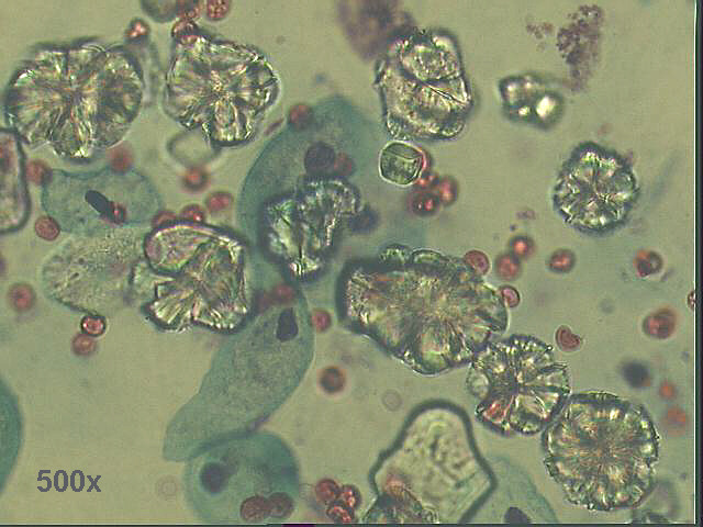 Enlargement of previous picture, 500x Pap staining