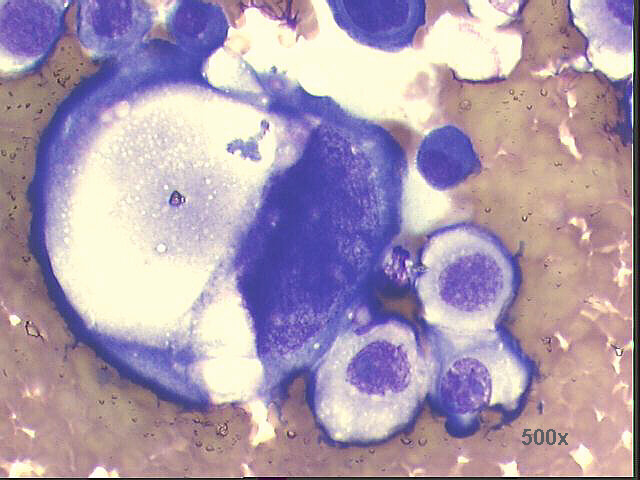 Squamous cell carcinoma, enlargement of previous picture, 500x M-G-G staining