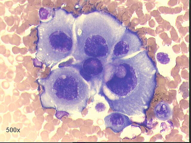 Squamous cell carcinoma, 500x M-G-G staining