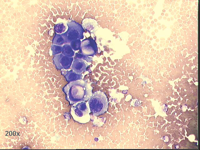 Squamous cell carcinoma, 200x M-G-G staining