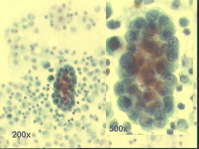 200x & 500x Pap staining