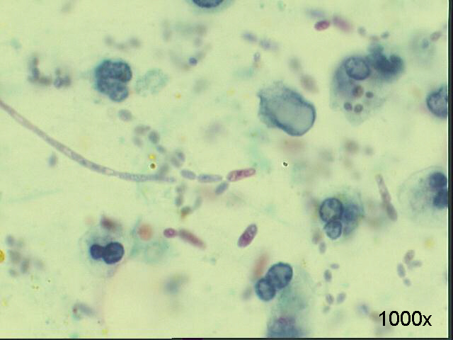 Many fungal elements 1,000x Pap staining