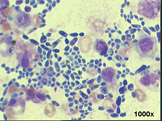 The M-G-G stain clearly shows the fungal elements: pseudo-hyphae and spores 1,000x M-G-G staining