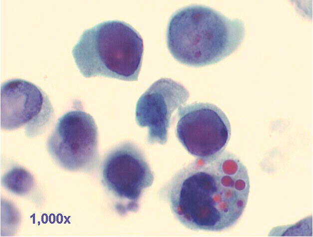 Decoy cells, Pap staining, 1,000x view shows tubular cells, with inclusion bearing and/or degenerated nuclei.