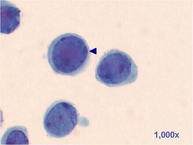 Decoy cells, Pap staining, 1,000x power view shows tubular cells, with inclusion bearing and/or degenerated nuclei, the arrow points to a cell with a Herpesvirus-like effect.