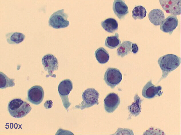 Decoy cells, Pap staining, 500x, shows abnormal looking tubular cells, with inclusion bearing nuclei